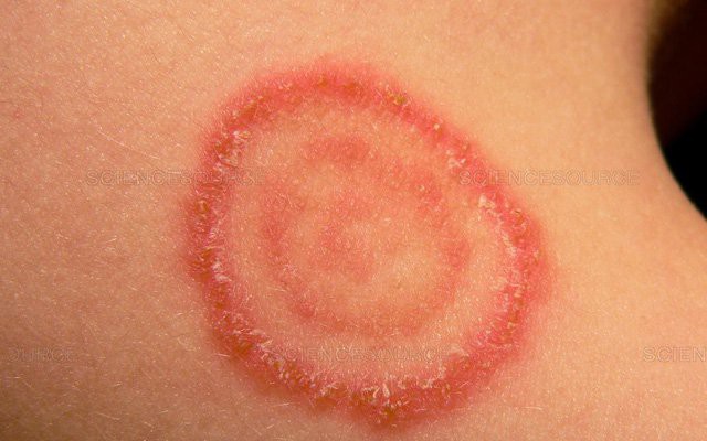 Nấm da: Biểu hiện thường gặp và sai lầm trong điều trị