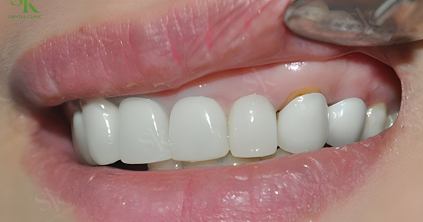 Vì sao bọc răng sứ hay bị viêm nướu?