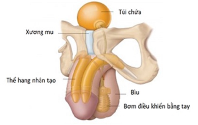 Điều trị rối loạn cương dương bằng lắp 'công tắc' nhân tạo- Ảnh 1.