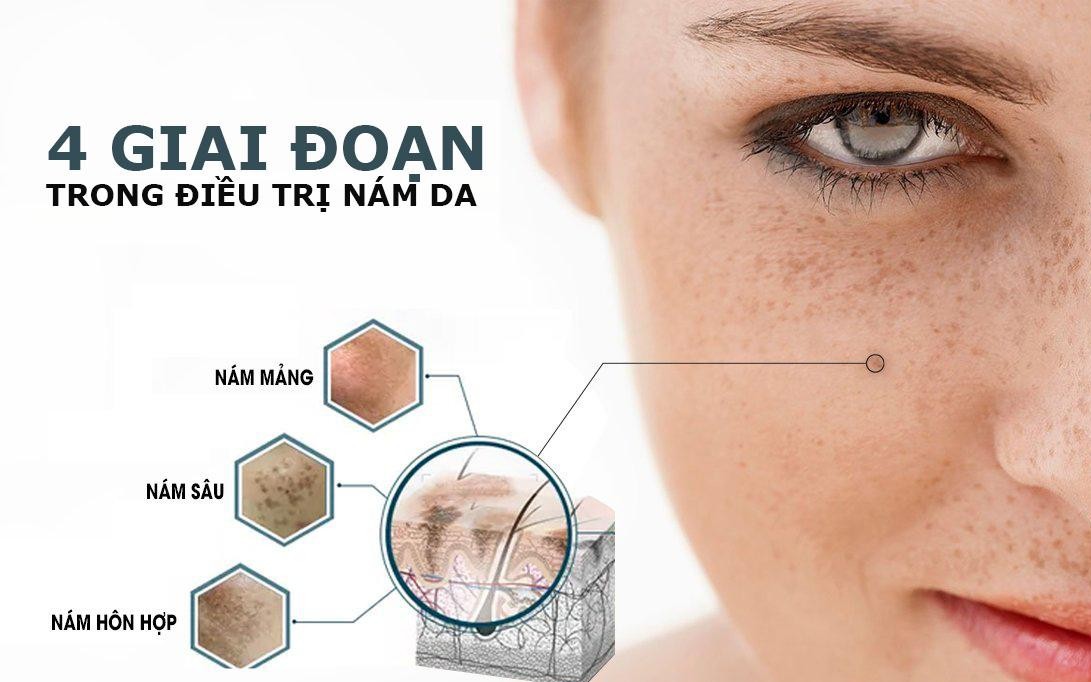 Chữa nám da ở mức độ trung bình