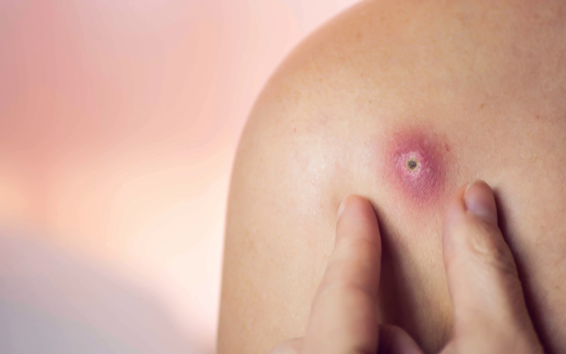 Cách chăm sóc da và phòng ngừa mụn hiệu quả- Ảnh 2.