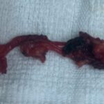 Đau âm ỉ vùng bụng, phát hiện bệnh hiếm nằm sát bàng quang