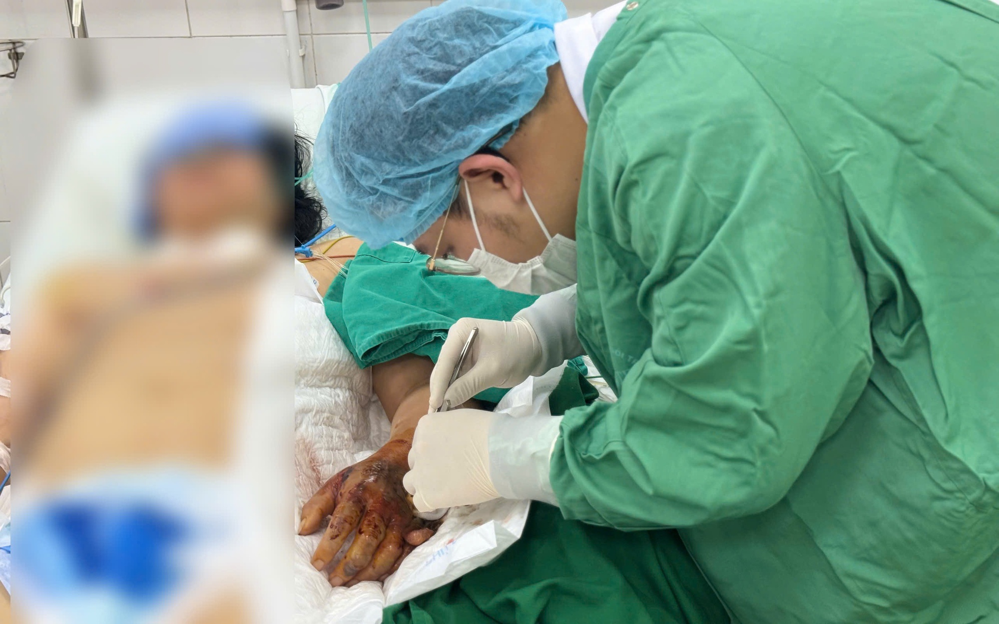 Hồi sinh đôi chân bị xe tải 10 tấn cán qua nhờ kỹ thuật hút áp lực âm- Ảnh 3.