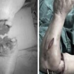 Hồi sinh cánh tay đứt lìa dập nát trong ‘giờ vàng’
