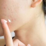 6 sai lầm khi chữa mụn trứng cá