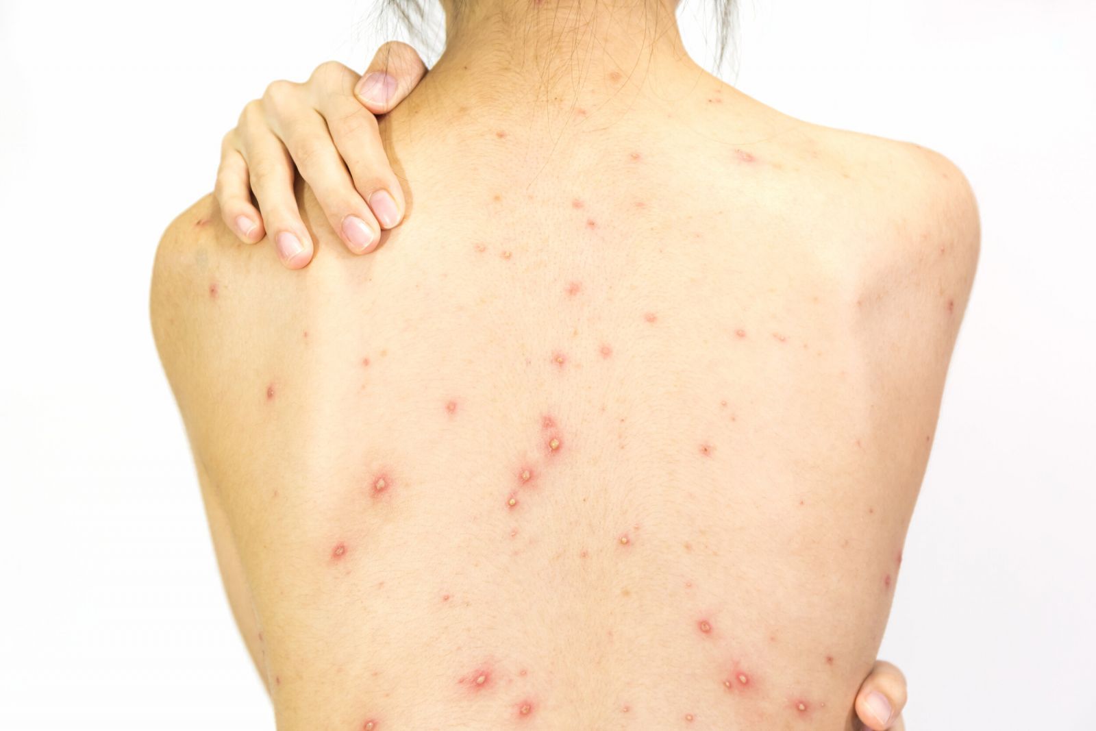 Nguyên nhân mọc mụn trứng cá ở lưng, yếu tố thường gặp nhưng dễ bị bỏ qua- Ảnh 1.