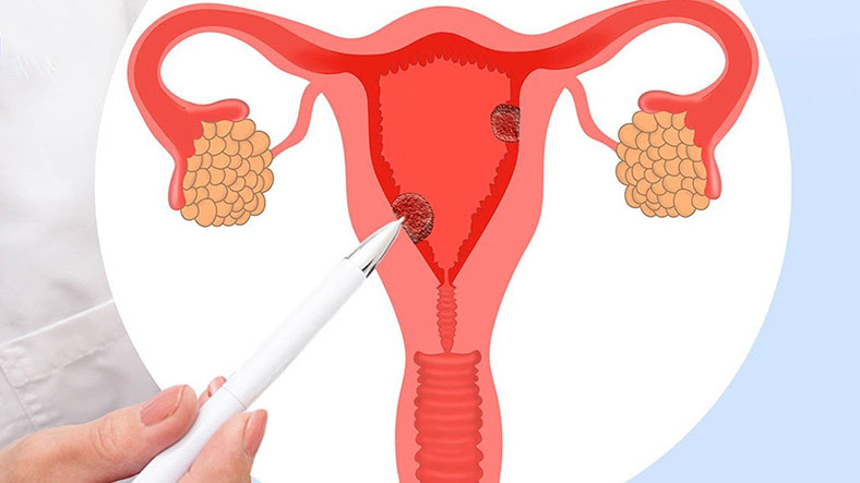 Hội chứng buồng trứng chuyển hóa đa nội tiết - tên gọi mới của hội chứng buồng trứng đa nang- Ảnh 1.