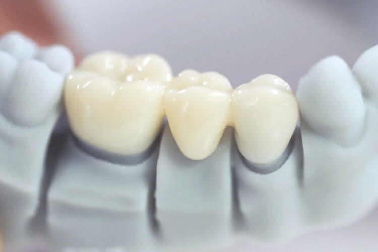 Bọc răng sứ bị viêm lợi (viêm nướu) thường xuất phát từ những sai sót trong kỹ thuật thực hiện hoặc thói quen chăm sóc sau khi bọc. Ảnh minh họa