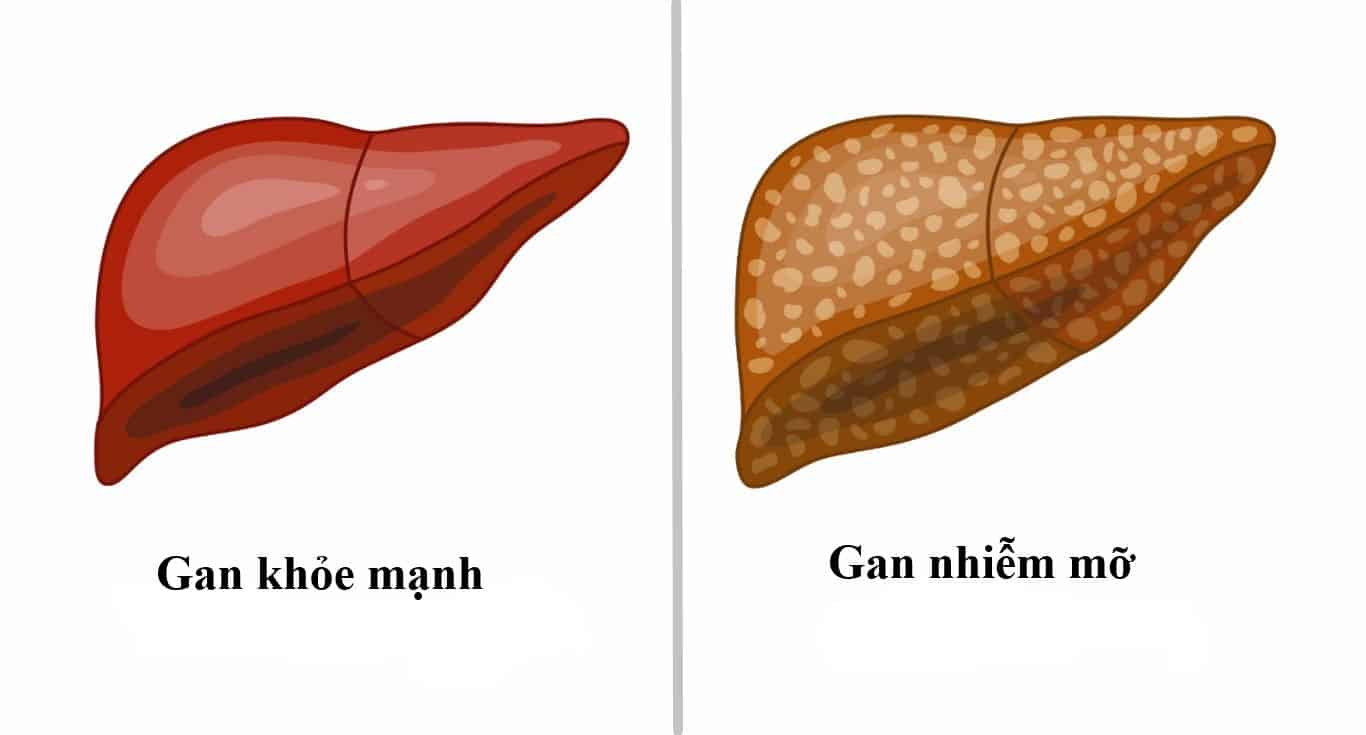 Chế độ ăn cho người gan nhiễm mỡ- Ảnh 2. Chế độ ăn cho người gan nhiễm mỡ- Ảnh 2.