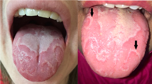 6 lưu ý về lưỡi bản đồ ở trẻ em- Ảnh 1.