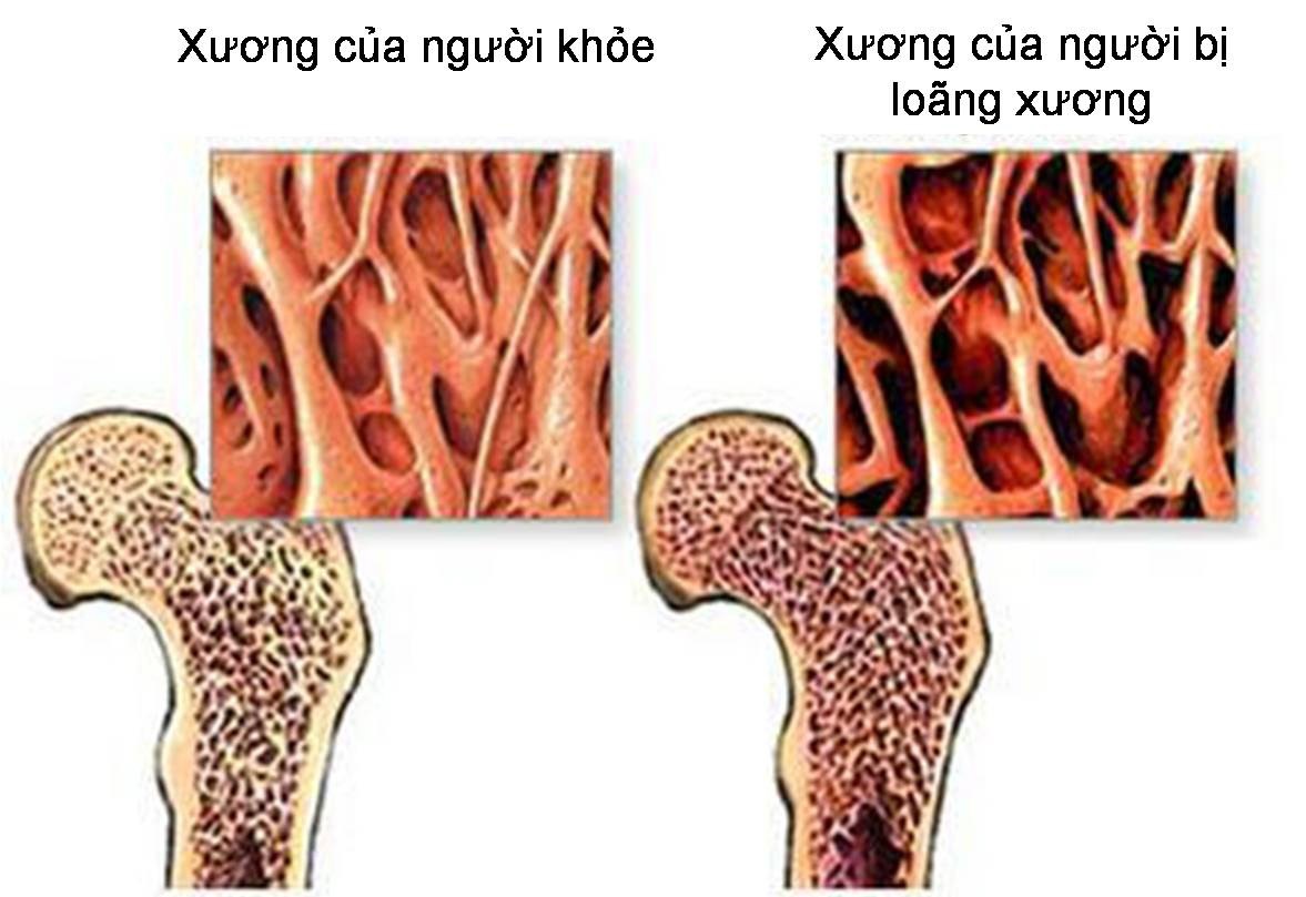 5 giải pháp đơn giản giúp duy trì xương chắc khỏe sau tuổi 50- Ảnh 1.