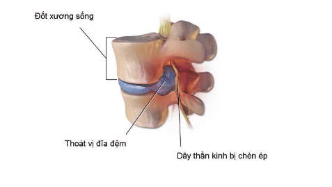 Giảm đau do thoát vị đĩa đệm ở người cao tuổi dùng thuốc như thế nào?- Ảnh 2.