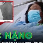 Tự ý dùng thuốc, người phụ nữ sốc nặng khi da bị tróc như ‘cua lột’