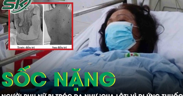 Tự ý dùng thuốc, người phụ nữ sốc nặng khi da bị tróc như ‘cua lột’