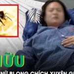 Ong chích xuyên giác mạc, người phụ nữ sưng phù mắt phải cấp cứu khẩn