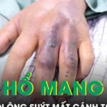 Đi làm ruộng bị rắn hổ mang cắn, người đàn ông suýt mất cánh tay
