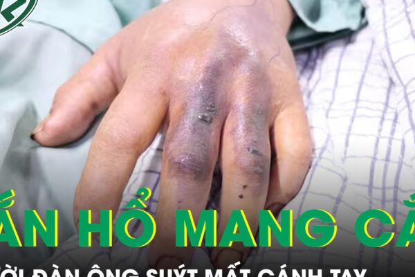 Đi làm ruộng bị rắn hổ mang cắn, người đàn ông suýt mất cánh tay