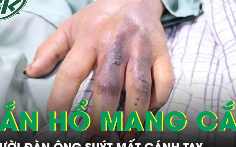 Đi làm ruộng bị rắn hổ mang cắn, người đàn ông suýt mất cánh tay