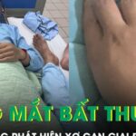 Da và mắt vàng bất thường, chàng trai 21 tuổi bàng hoàng phát hiện xơ gan giai đoạn cuối