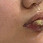 Biến dạng môi sau tiêm ‘giải filler’ tại spa