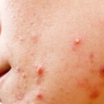 Mụn trứng cá bọc có nên nặn không?