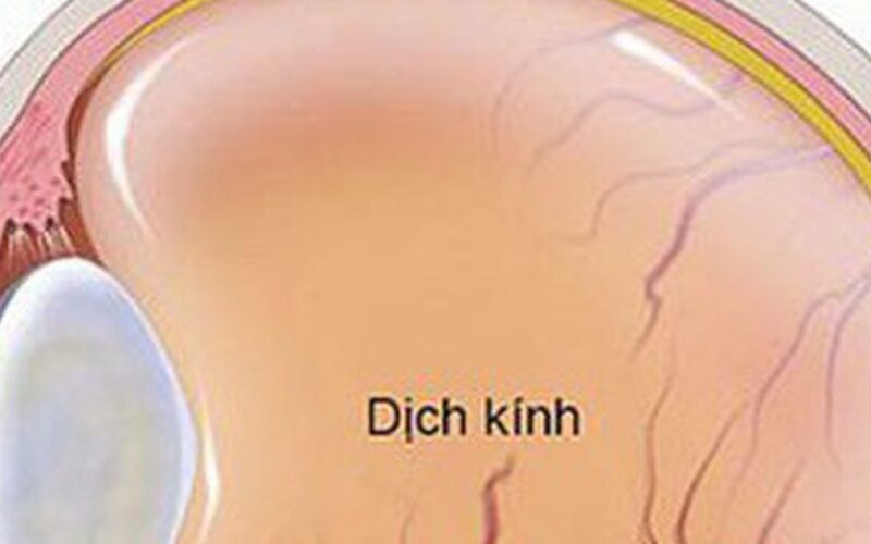 Ruồi bay trước mắt có thể là dấu hiệu xuất huyết dịch kính nguy hiểm