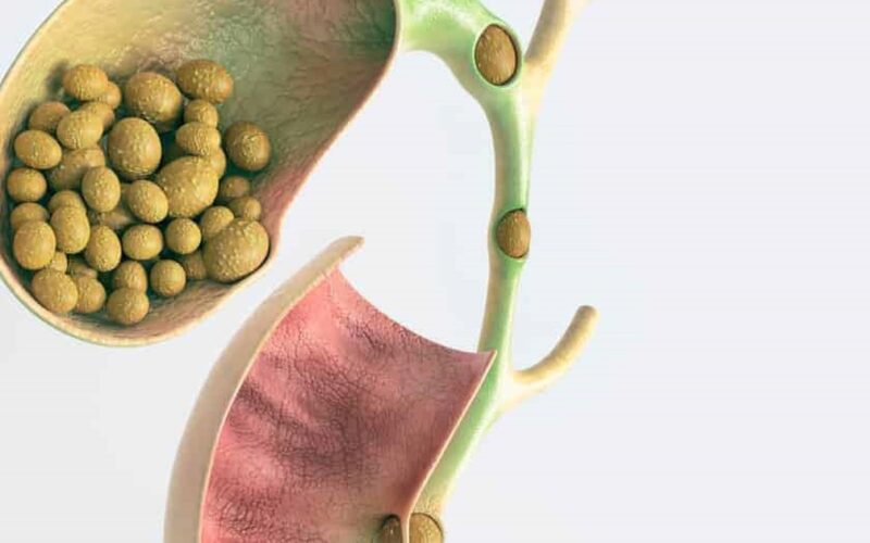 Sỏi túi mật hình thành do đâu và cách phòng ngừa hiệu quả