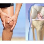 Đau khớp gối khi leo cầu thang có đáng lo?