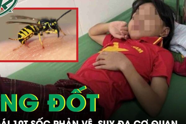 Ong vò vẽ đốt 70 vết, bé gái 10 tuổi sốc phản vệ, suy đa cơ quan phải cấp cứu gấp