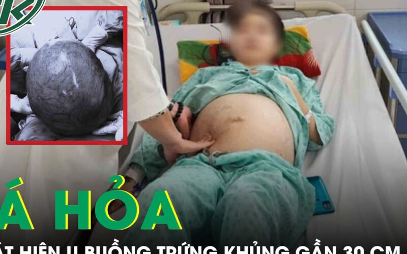 Tá hoả phát hiện khối u buồng trứng ‘cực khủng’ gần 30cm từ dấu hiệu đau bụng