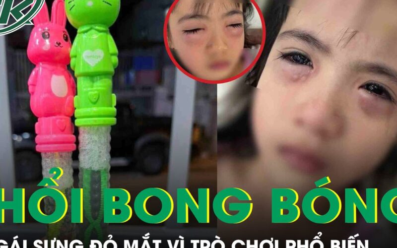Chơi bong bóng xà phòng, bé gái 5 tuổi sưng đỏ 2 mắt phải cấp cứu khẩn