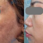 Bác sĩ chỉ rõ lý do nhiều người trị nám tốn kém nhưng vẫn tái phát