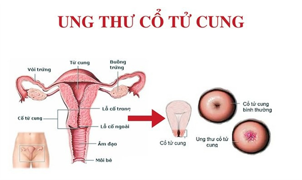 Tầm soát ung thư cổ tử cung tại y tế cơ sở: Lợi ích và hiệu quả năm 2023 - Ảnh 2. Tầm soát ung thư cổ tử cung tại y tế cơ sở: Lợi ích và hiệu quả năm 2023 - Ảnh 2.
