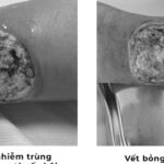 Tự chữa bỏng bằng thuốc dân gian, người đàn ông suýt hoại tử chân