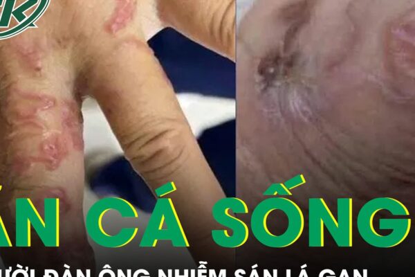 Ăn cá sống, người đàn ông bị nhiễm sán lá gan