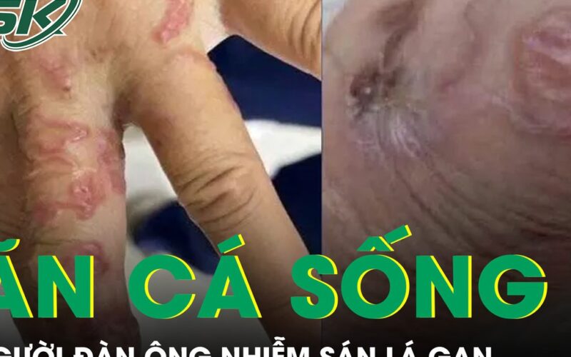 Ăn cá sống, người đàn ông bị nhiễm sán lá gan