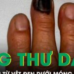 Bàng hoàng phát hiện ung thư da từ vệt đen dưới móng tay
