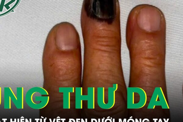 Bàng hoàng phát hiện ung thư da từ vệt đen dưới móng tay