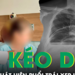 Ho kéo dài nhiều tuần, người phụ nữ bất ngờ phát hiện phổi trái xẹp hoàn toàn vì bệnh hiếm