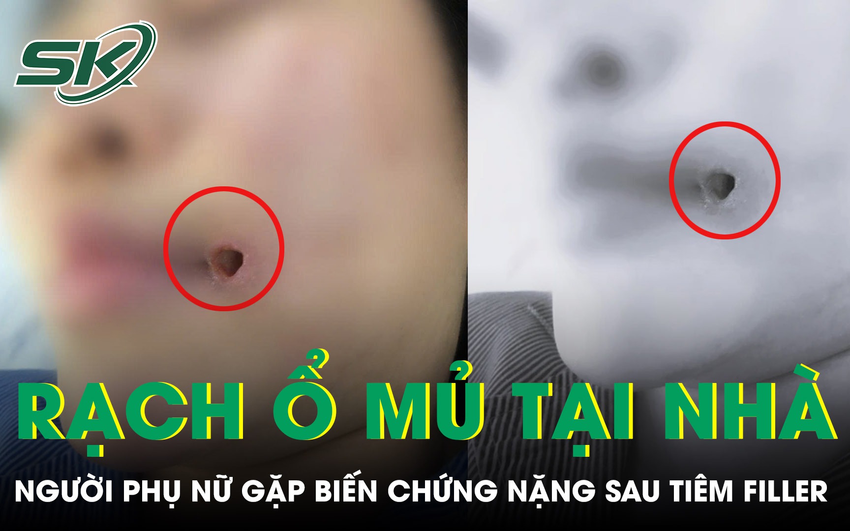 Biến dạng môi sau tiêm 'giải filler' tại spa- Ảnh 2.