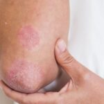 Người mắc bệnh vảy nến đối mặt áp lực tâm lý kéo dài nhiều năm