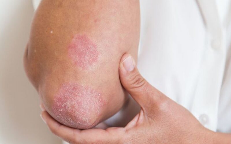Người mắc bệnh vảy nến đối mặt áp lực tâm lý kéo dài nhiều năm