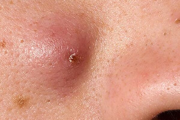 Cách chữa mụn nhọt hiệu quả