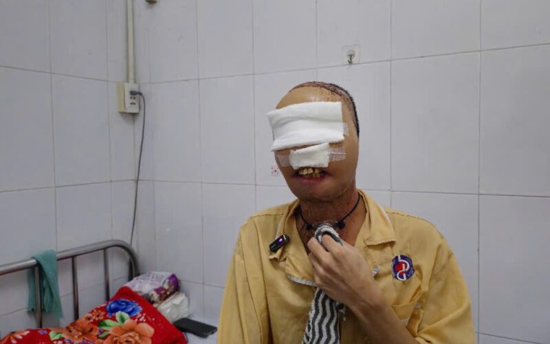 Hành trình ‘làm lại gương mặt’ cho chàng thanh niên mang di chứng bỏng suốt 3 năm
