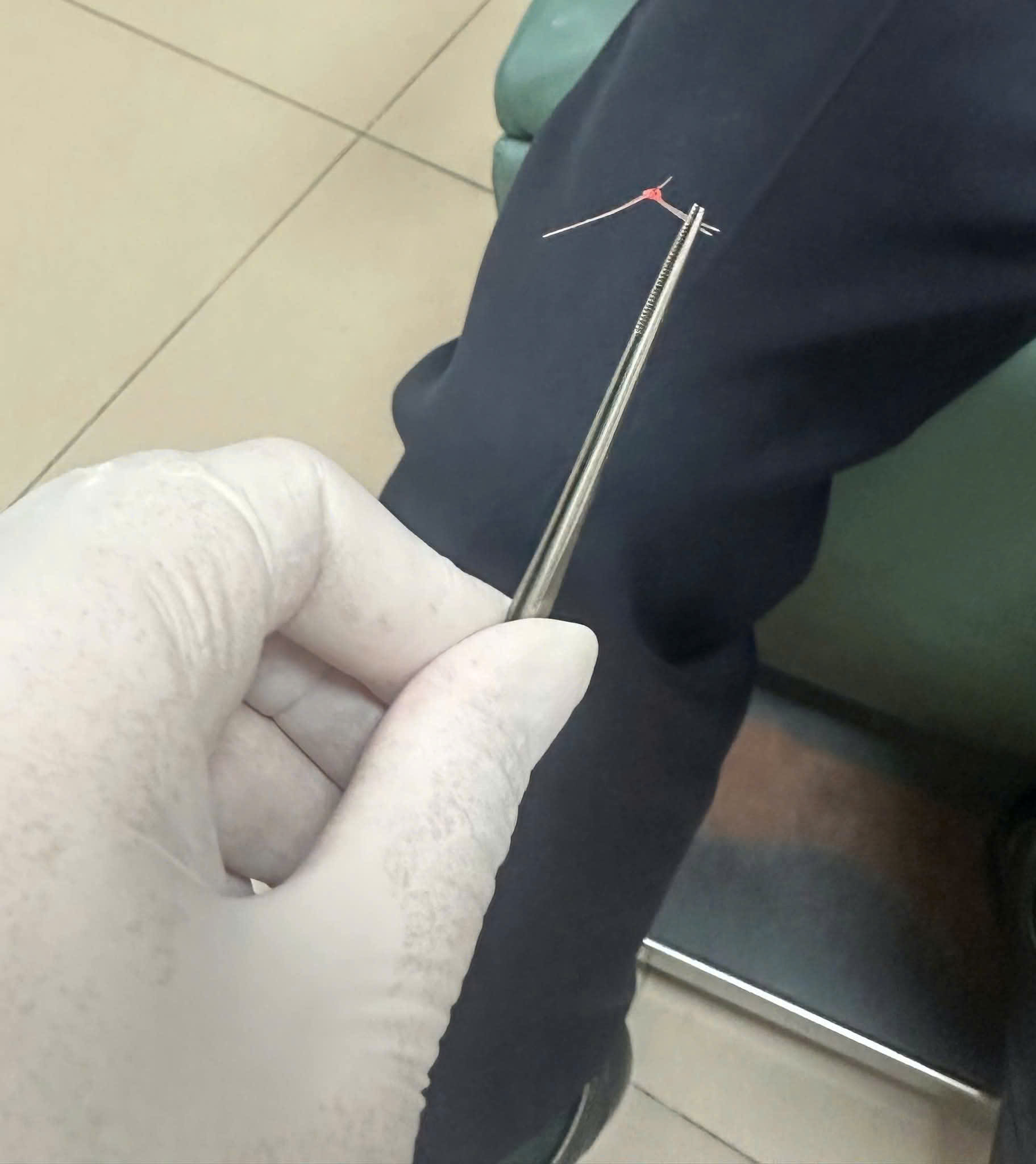 hoc-xuong-ca-17780465642921197012882 Hi hữu hóc lông lợn sau khi ăn bánh mỳ pate- Ảnh 3.
