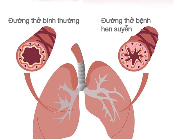 photo-1779958839956-17799588404401266457370 Cách phòng ngừa bệnh hen suyễn và bác sĩ chữa hen giỏi Hà Nội