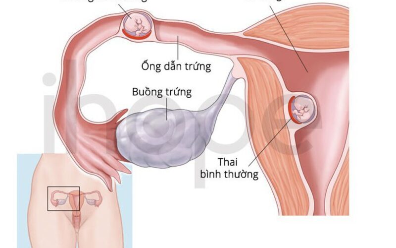 Hiếm gặp: Vừa có thai trong tử cung vừa có thai ngoài tử cung
