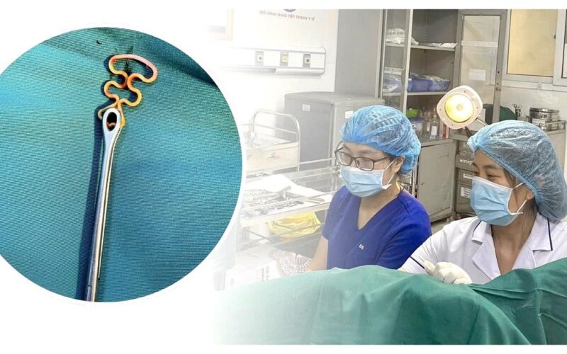 Bỏ quên vòng tránh thai suốt 30 năm, người phụ nữ 63 tuổi gặp biến chứng phụ khoa
