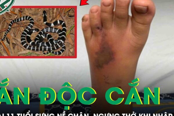 Bé trai 11 tuổi bị rắn độc cắn, sưng nề chân, ngưng thở khi nhập viện