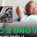 Người đàn ông 56 tuổi mắc cùng lúc hai ung thư sau 30 năm hút thuốc lá